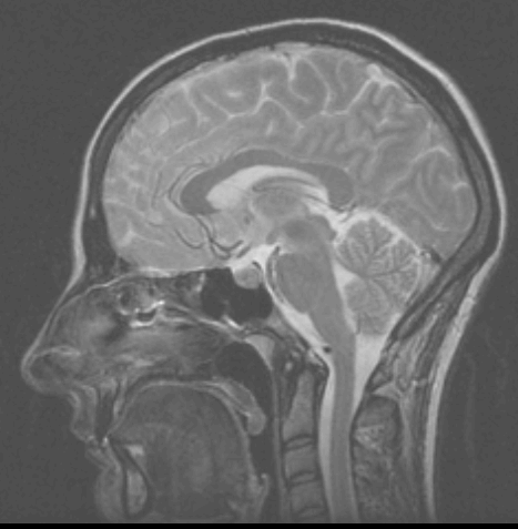 Midsagittal section of head