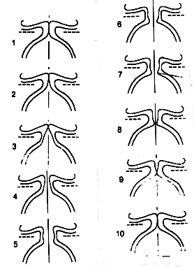 Mucosal wave